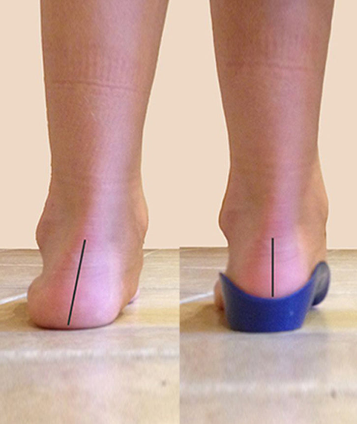 OVERPRONATION