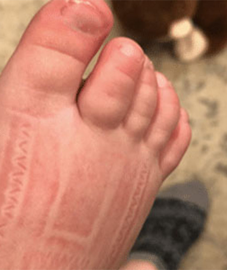 SWOLLEN FEET